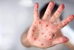 CDMX registra 5 nuevos casos de sarampión en la última semana